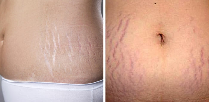 estrias blancas y rojas